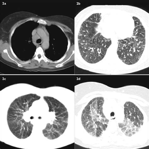 Axial Ct Images Of The Chest Show A Enlarged Paratracheal