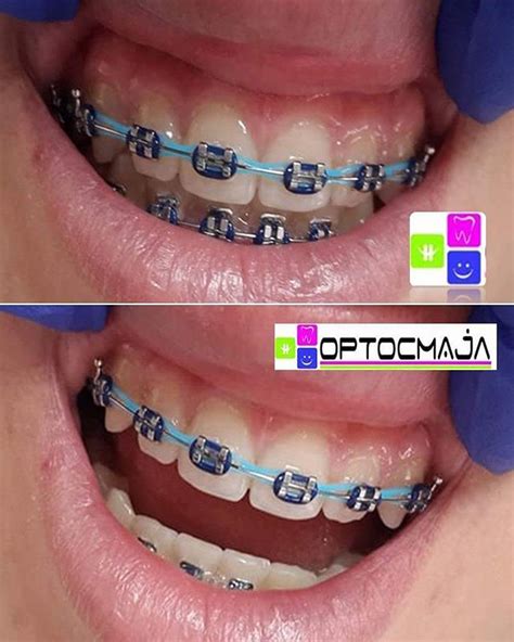 10 Colored Blue Braces For Adults And Kids Braces Explained