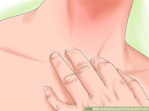 Ways To Diagnose And Treat Scarlet Fever WikiHow Health