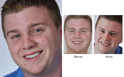 In the upper row, the common signs of crowding are the. How to get straight teeth without braces or invisalign ...