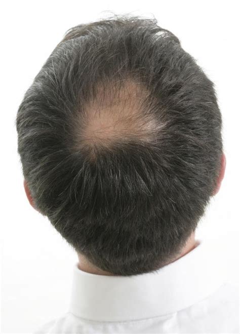 What Are The Different Types Of Hair Restoration Products