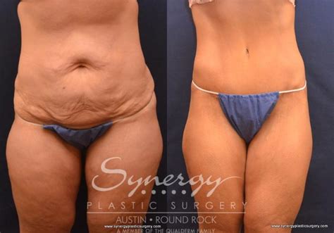 Post Weight Loss Surgery Before And After Photo Gallery Austin TX Synergy Plastic Surgery