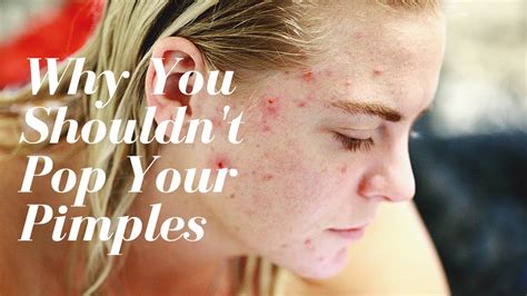 Why You Shouldnt Pop Your Pimples🙀what Will Happen If You Pop Your