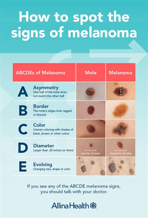 Melanoma And Your Moles Know Whats New Allina Health