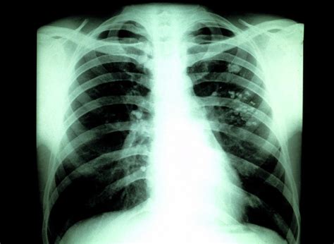 Tuberculosis X Ray Photograph By Cnriscience Photo Library Fine Art