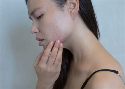 Understanding And Treating Stress Rash Facty Health
