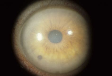 Corneal Dystrophy Congenital Endothelial 1 Hereditary Ocular Diseases