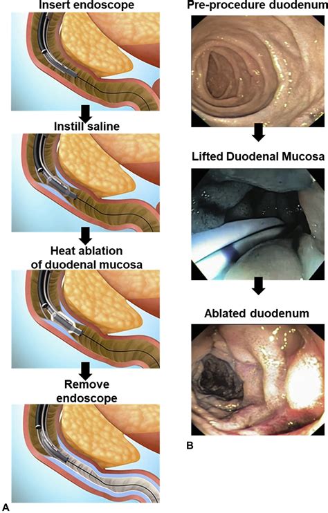 Duodenal Mucosal Resurfacing Proof Of Concept Procedural Development