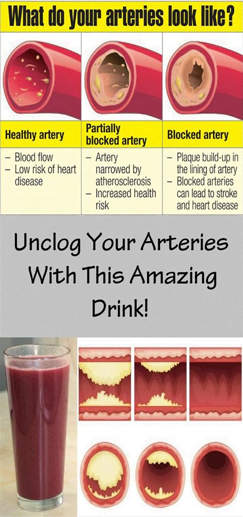 Unclog Your Arteries With This Amazing Drink Clogged Arteries