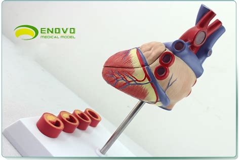 Enovo11人体心脏模型 动脉粥样硬化模型 血栓心内科教学 阿里巴巴