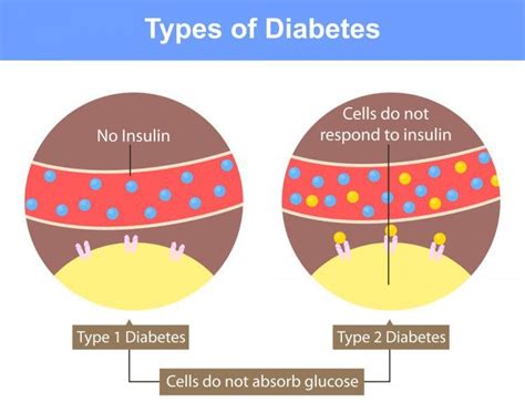 Diabetes Type 1 Vs Type 2 What Are The Differences