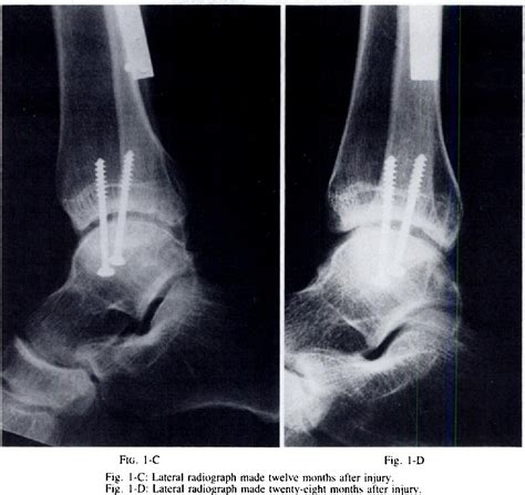Figure From Posterior Malleolar Fractures Of The Ankle Associated With External Rotation