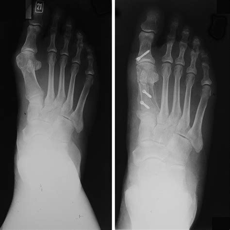 Scarf Akin Osteotomy Correction For Hallux Valgus Short Term Results