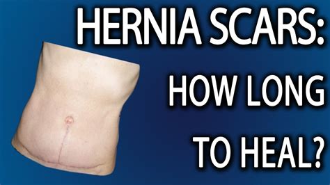 Hernia Scar Tissue How Long To Heal Youtube