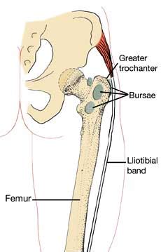 Hip Pain Trochanteric Bursitis Injection Pain In Left Side Above Hip