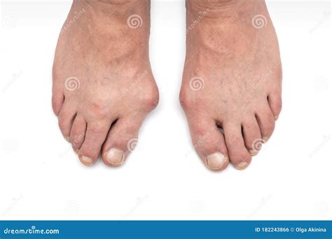 Varus Valgus And Hallux Valgus Or Bunion On Middle Aged Woman Foot Isolated Closeup On White
