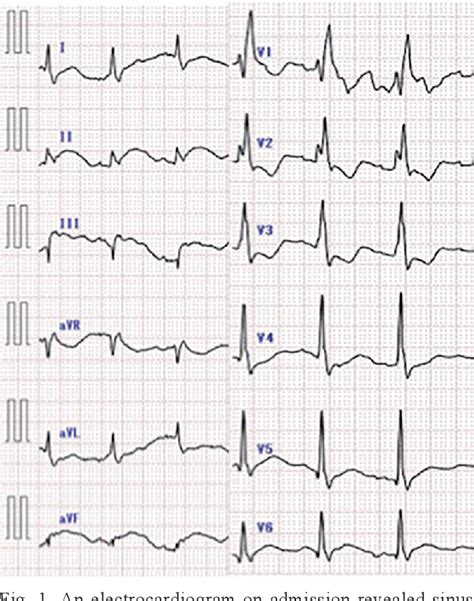 Figure 1 From A Rare Case Of Rapidly Progressing Beriberi Heart