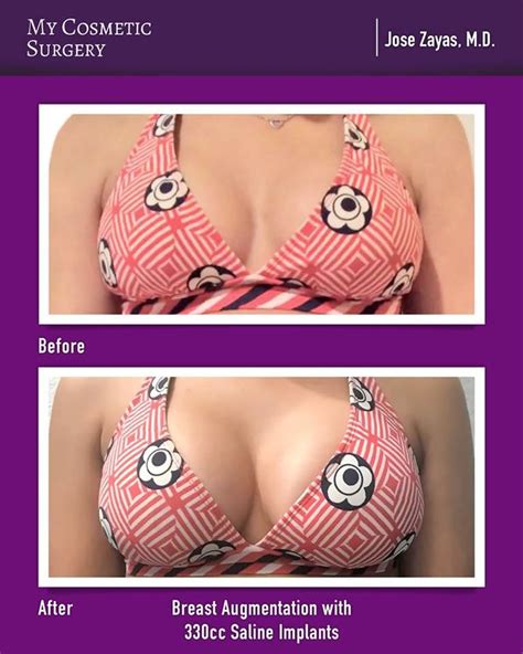 Collection Pictures Breast Augmentation Surgery Pictures Excellent