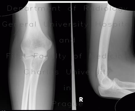 Radiology Case Effusion In Elbow Joint Sail Sign Fracture Of Head Of