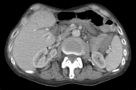 Computed Tomography Scan Of The Abdomen And Pelvis With Intravenous