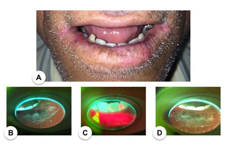 Blue Light Photodiagnosis Sequence A Clinical Findings Of Actinic