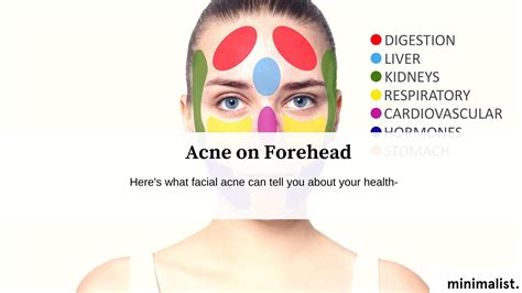Forehead Acne Causes And Treatment Minimalist