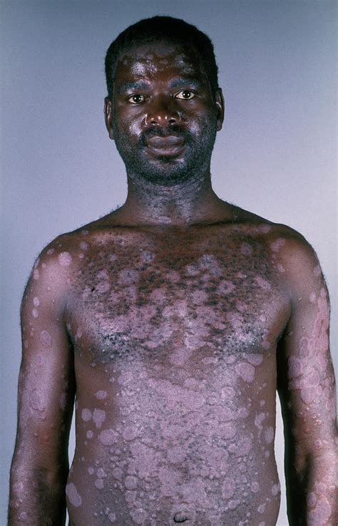 Psoriasis In Aids Patient Photograph By Dr Ma Ansaryscience Photo