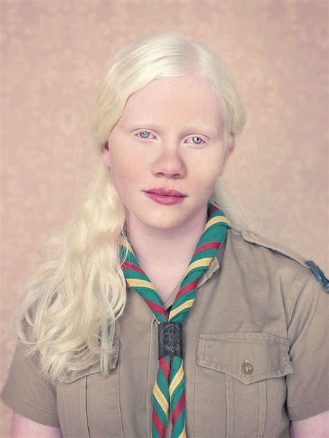 Pin On Albino People