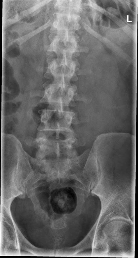 Normal lumbar lordosis measurement, the retrospective approach is a credible alternative to. the xray doctor: xrayoftheweek 4: why has this man got ...