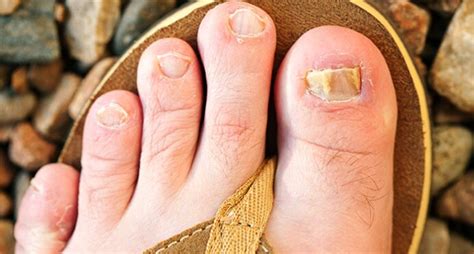 Vinegar cures for toenail fungus. Quiz: Myths and Facts About Toenail Fungus