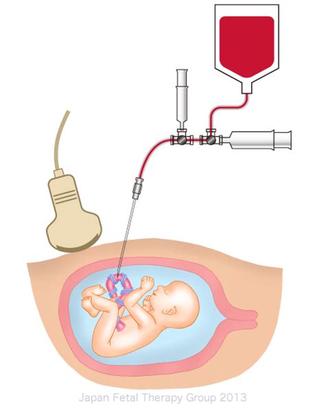 Transfusiones Intrauterinas Para Tratar La Anemia Fetal El Territorio Sexiz Pix