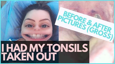 Adult Tonsillectomy My Experience And Advice Pictures Youtube