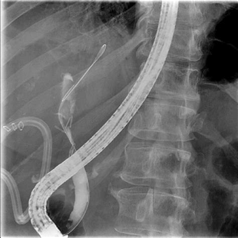 Endoscopic Retrograde Cholangiography Ercp Showing The Guide Wire