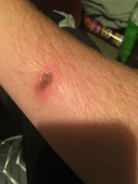 Got Bit By A Brown Recluse Spider Extremely Painful And Can Take Up To