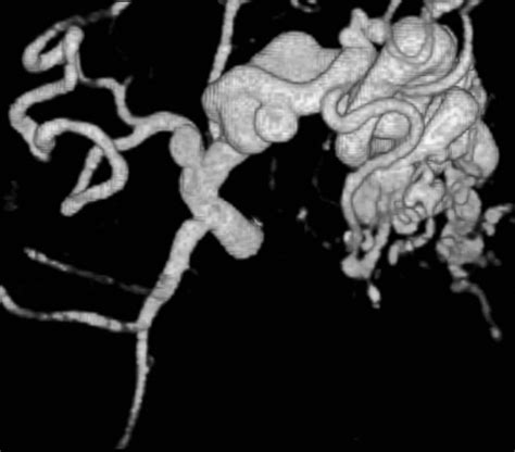 Visceral Artery Aneurysms Evaluation Using 3d Contrast Enhanced Mr Angiography Ajr