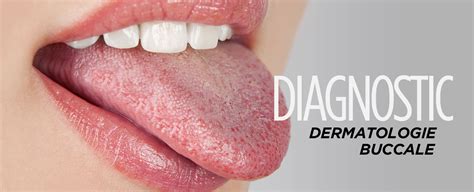 Dermatologie Buccale Lésions De La Langue Et De La Bouche Dr Lotfi