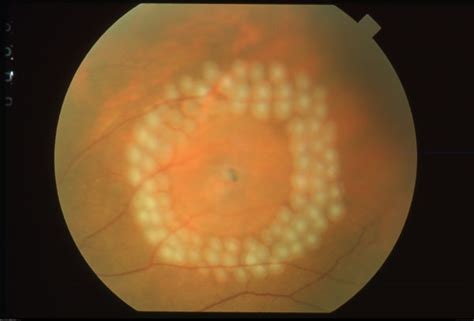 Learn About Retinal Tear Treatment Options In Sarasota