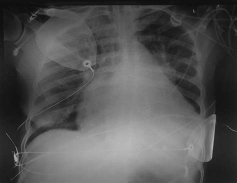 Chest Radiograph Showing Cardiomegaly With Upper Lobe Diversion Of The