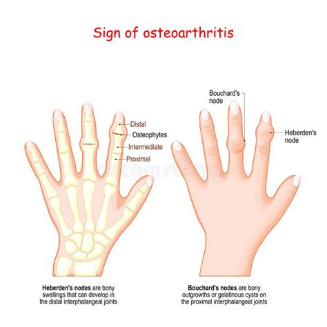Sign Of Osteoarthritis Human Hand With Heberden`s Node And Bouchard`s