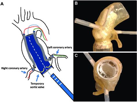 In Vitro Deployment Of A Device Combining An Ascending Aorta Endograft