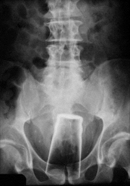 Real X Rays That Will Shock And Astound You 21 Pics Izismile Com