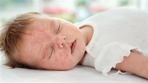 Baby Eczema Symptoms Causes Treatment Preventions