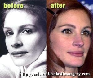 Julia Roberts Plastic Surgery Before After Pictures