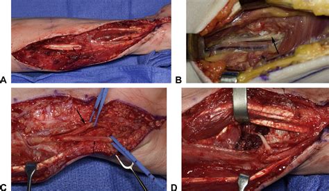 Management Of Ulnar Nerve Injuries Journal Of Hand Surgery