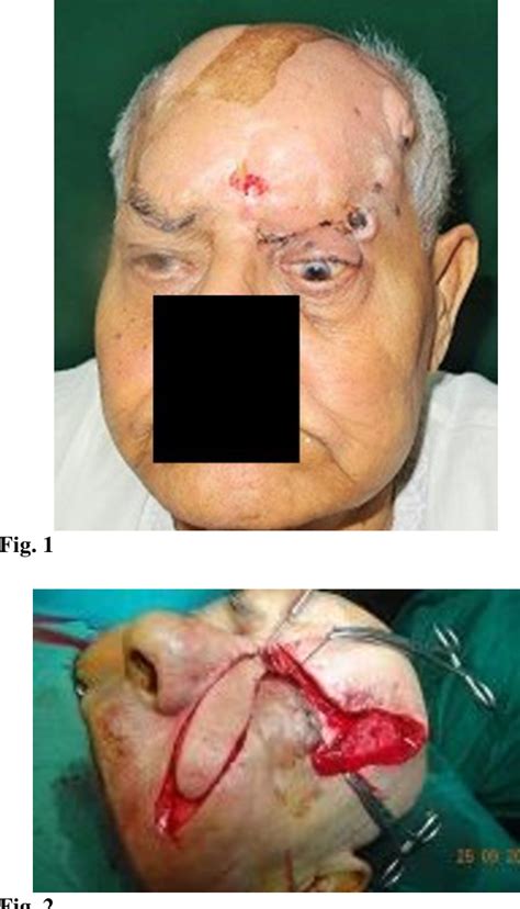 Figure From Recurrent Multifocal Basal Cell Carcinoma Of Upper Lid And Forehead Semantic