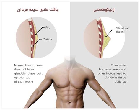 ژنیکوماستی، علایم، داروها و جراحی آن ایران بدن