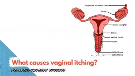 What Causes Vaginal Itching Vaginal Yeast Infections Youtube