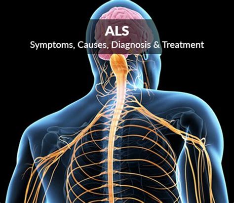 Als Amyotrophic Lateral Sclerosis Symptoms Causes Diagnosis Treatment ⋆