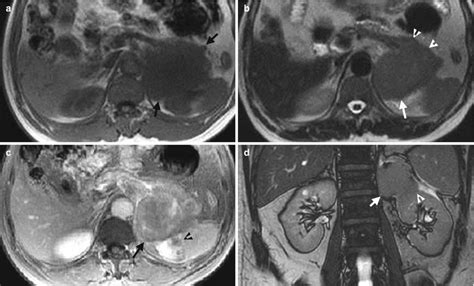 Retroperitoneal Diseases Radiology Key