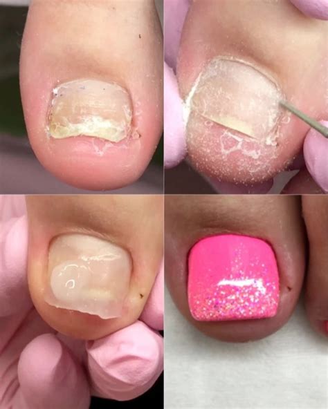 Broken Nails Transformation Pedicure Tutorials K Fashion